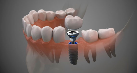 Implantes dentales, reponiendo piezas dentales perdidas